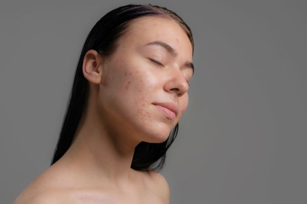 bio kozmetika na akné